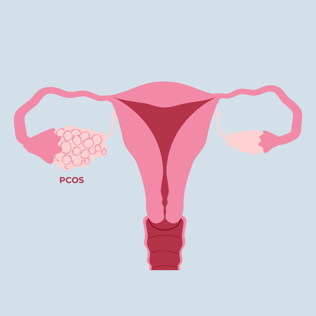 PCOS - What It Is and How It Can Be Managed?