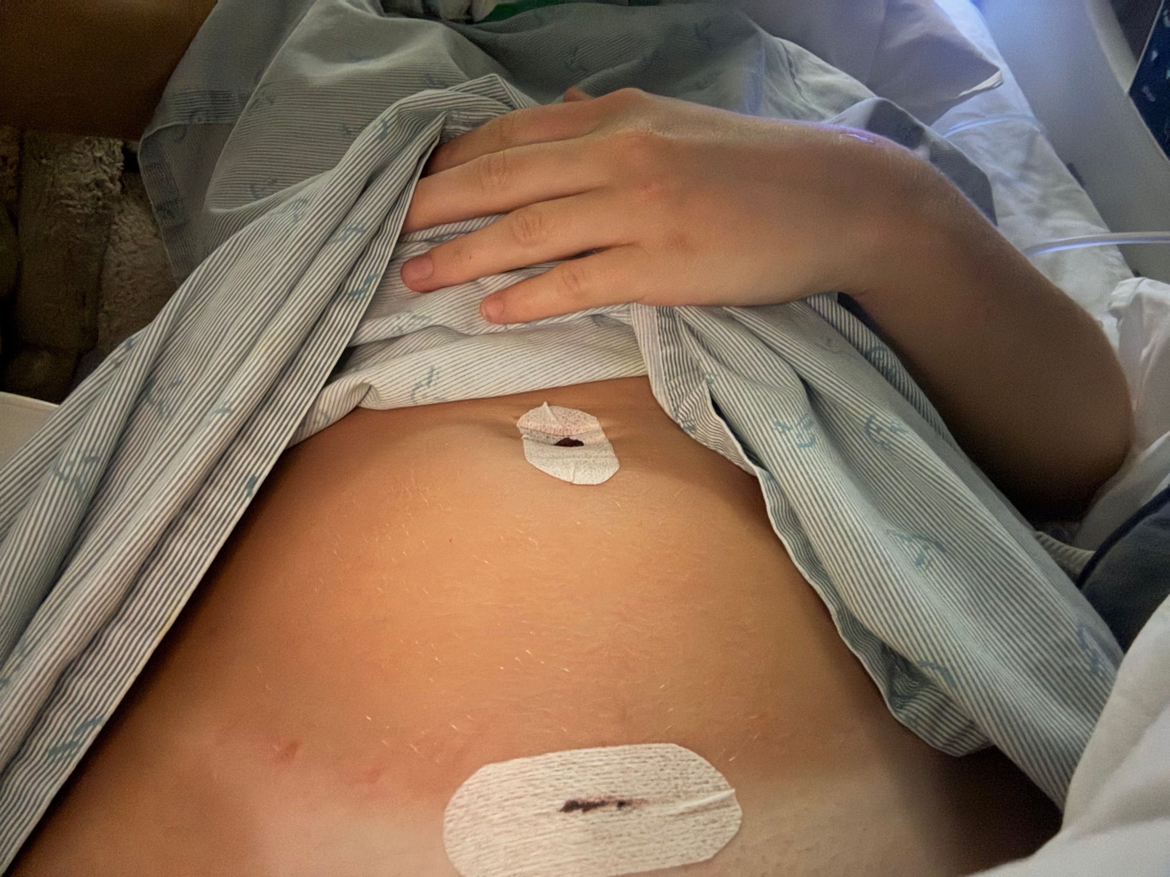 What Happens During Endometriosis Surgery?